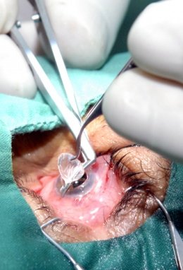 Especialistas realizan una operación de córnea.