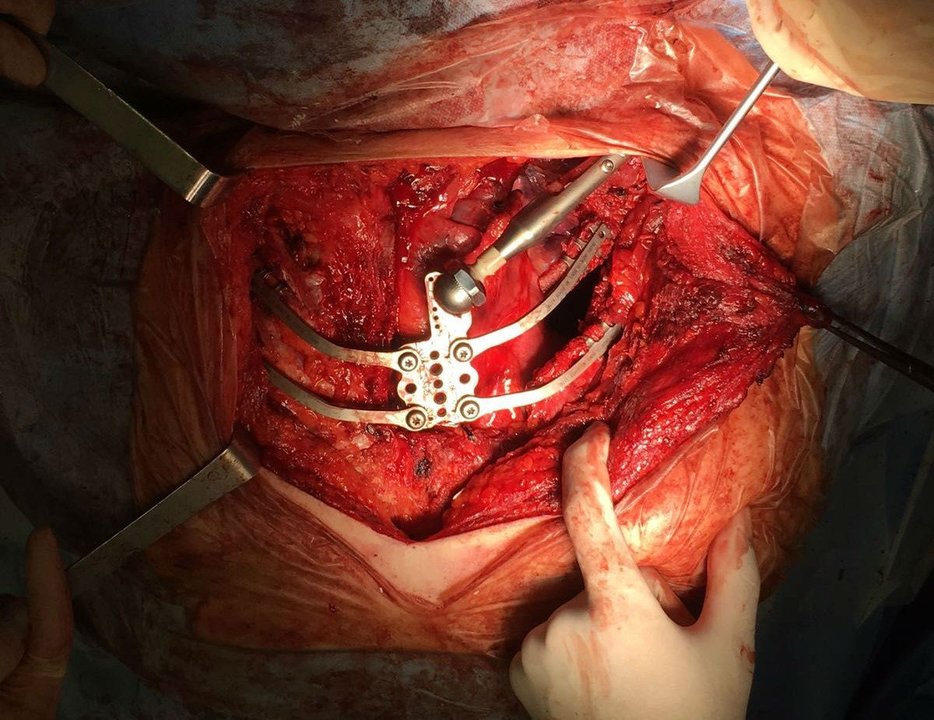 La prótesis de titanio fue echa a medida de la paciente. // Sergas