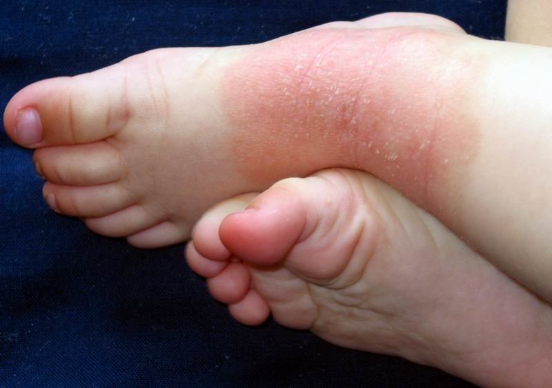 La dermatitis atópica es una enfermedad inflamatoria crónica de la piel