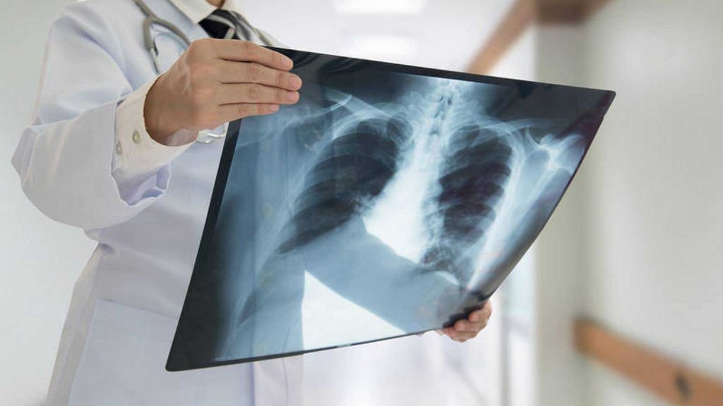 Un médico sostiene una placa de los pulmones de un paciente.