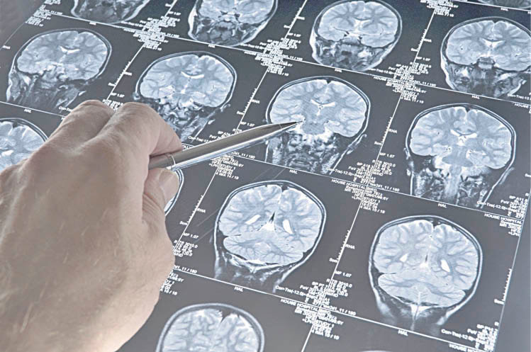 Un médico analiza una radiografía del cerebro de un enfermo de alzhéimer.