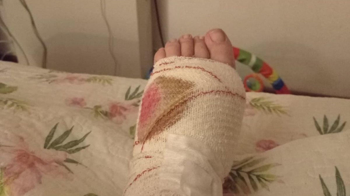 Tania tiene una herida importante en el pie a causa de la mordedura.